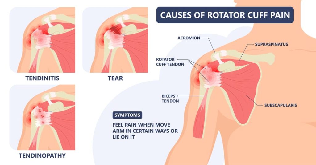 Rotator Cuff & Shoulder Pain Relief Lansdowne, VA - Nova Rehab