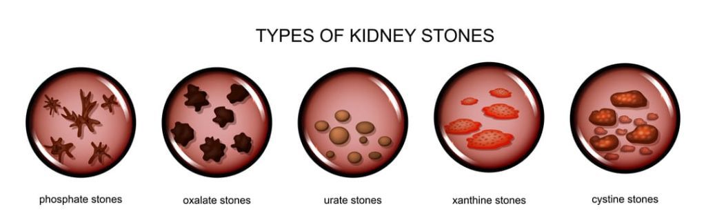 VA DISABILITY RATING FOR KIDNEY STONES