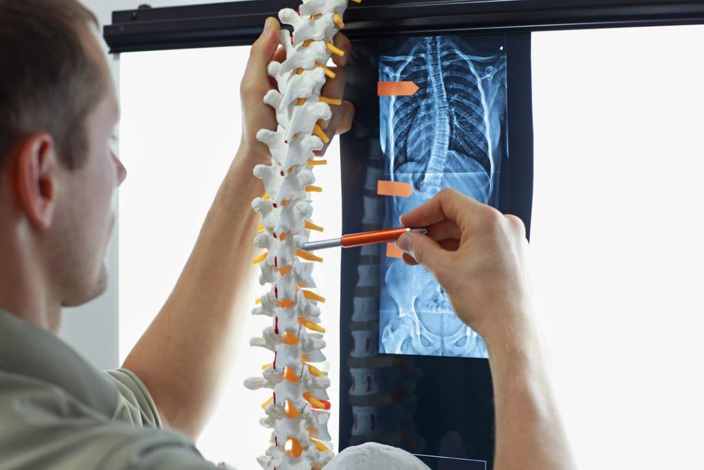 VA DISABILITY RATING FOR SCOLIOSIS