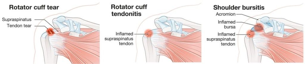 VA DISABILITY RATING FOR SHOULDER IMPINGEMENT