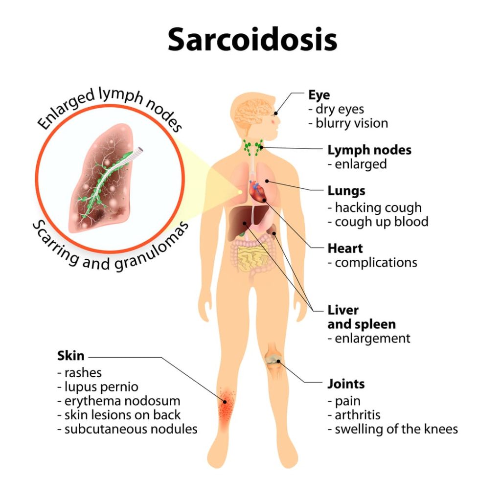 VA RATING FOR SARCOIDOSIS 1