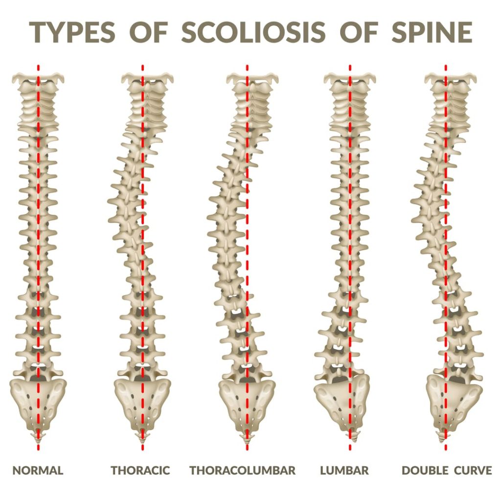 VA SCOLIOSIS RATINGS