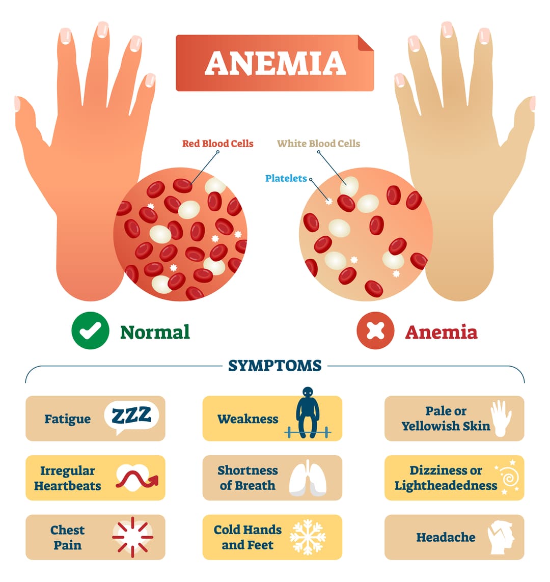 VA Rating For Anemia Explained!