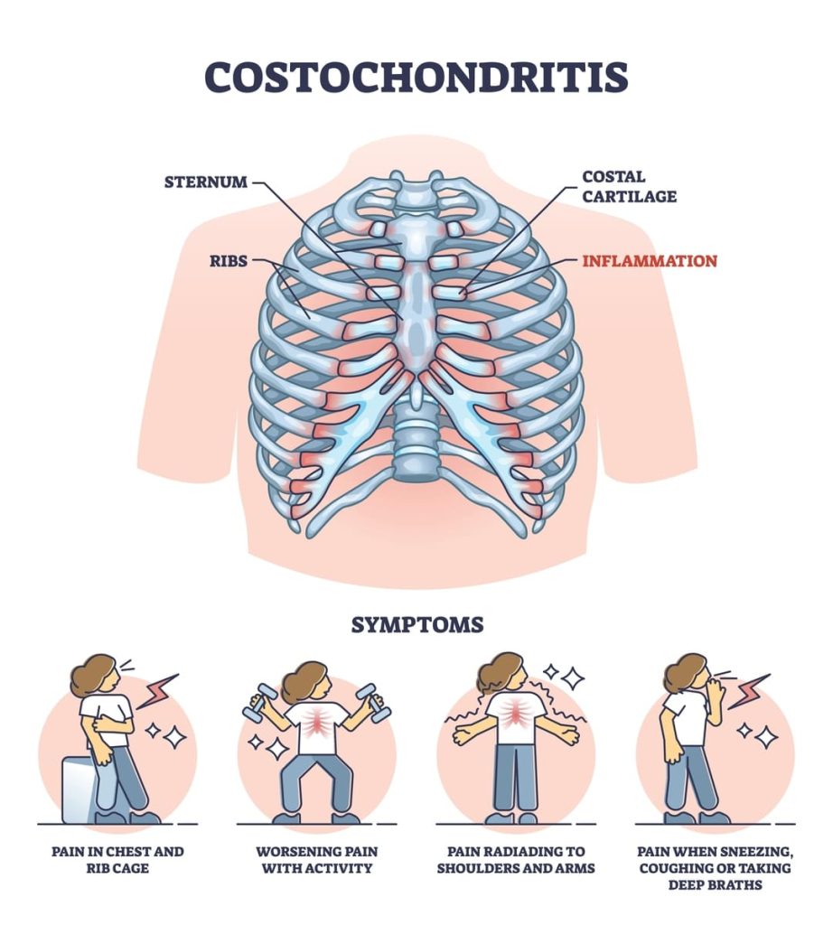 CAN COSTOCHONDRITIS CAUSE SHORTNESS OF BREATH 1