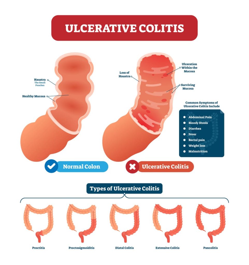 VA DISABILITY FOR ULCERATIVE COLITIS