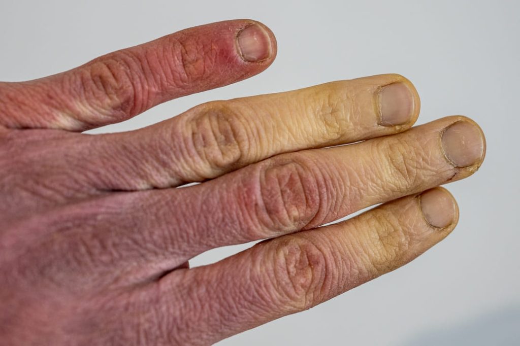 VA DISABILITY RATING RAYNAUDS SYNDROME.