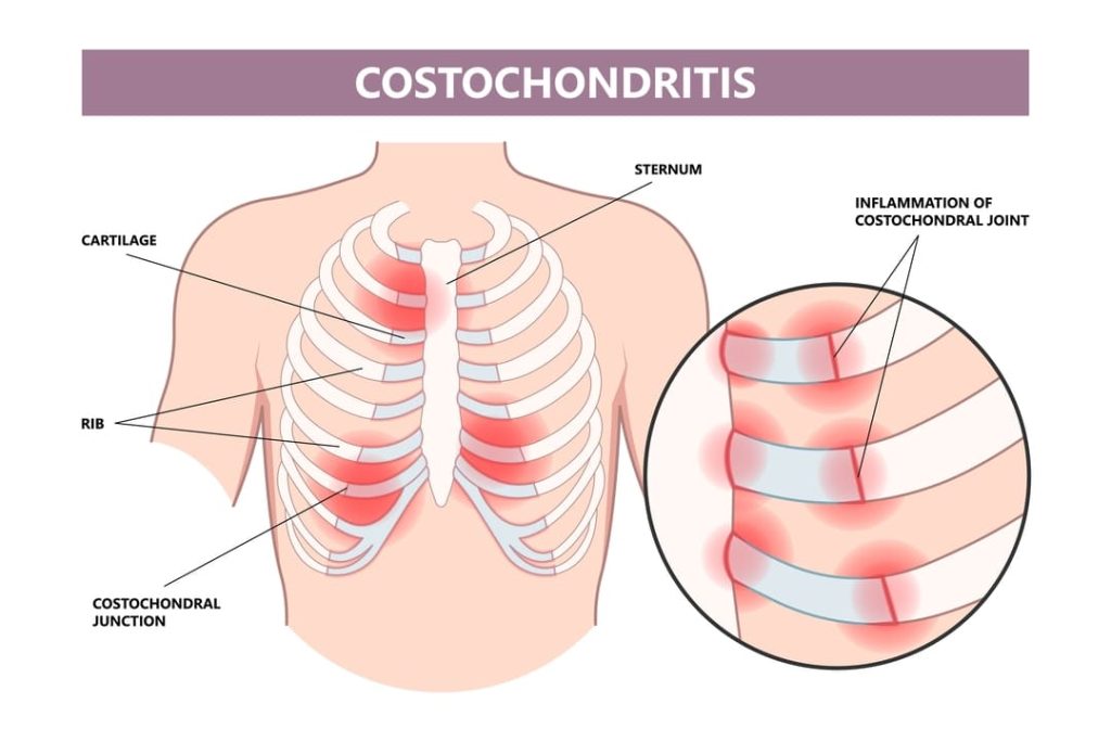 VA RATING FOR COSTOCHONDRITIS 1