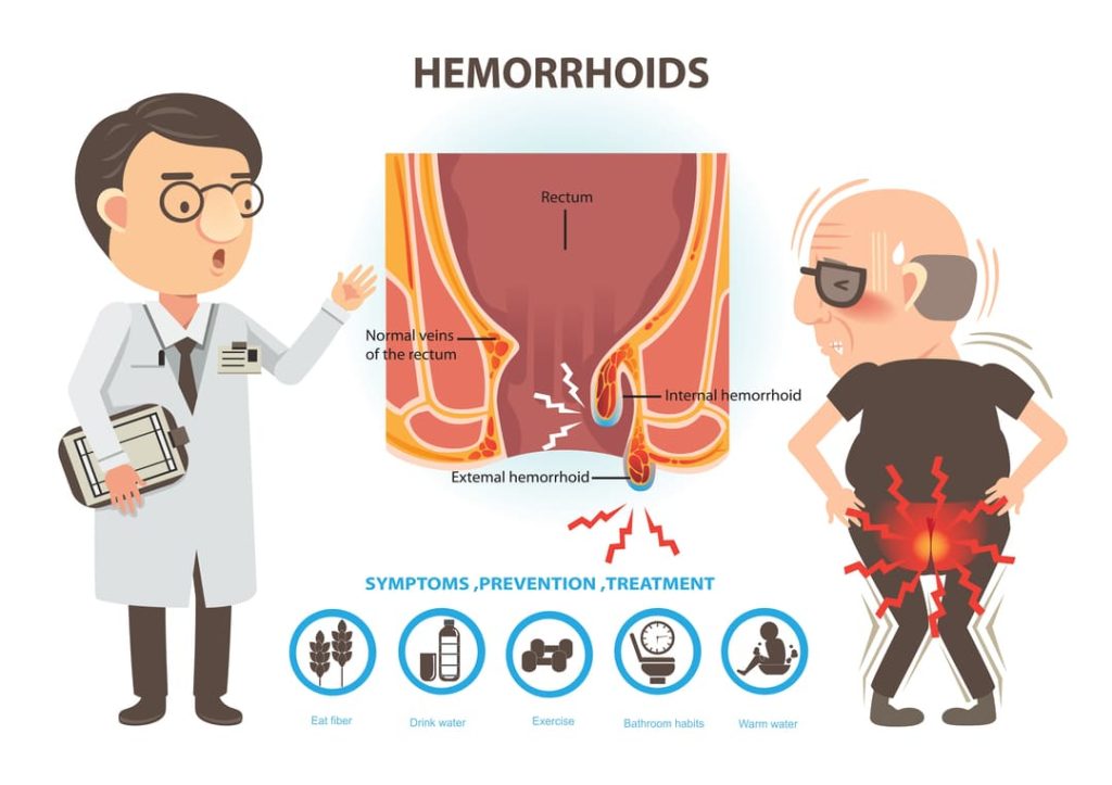 HEMORRHOIDS infographic with symptoms, prevention, and treatment.