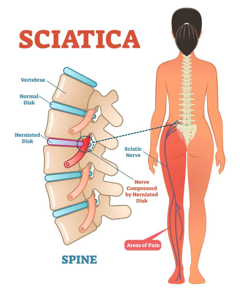 Sciatica (paralysis of the sciatic nerve) is the #6 most often claimed and service-connected VA disability