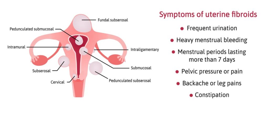 FIBROIDS VA RATING