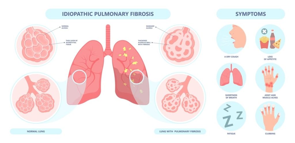 VA DISABILITY RATINGS FOR PULMONARY FIBROSIS