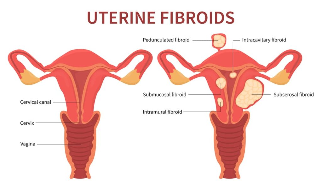 VA RATING FOR FIBROIDS