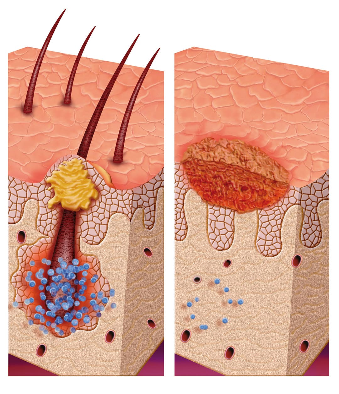 5 Steps to Winning a Pseudofolliculitis Barbae VA Rating