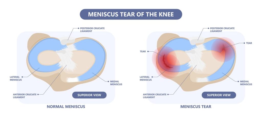 MENISCUS TEAR DIAGRAM