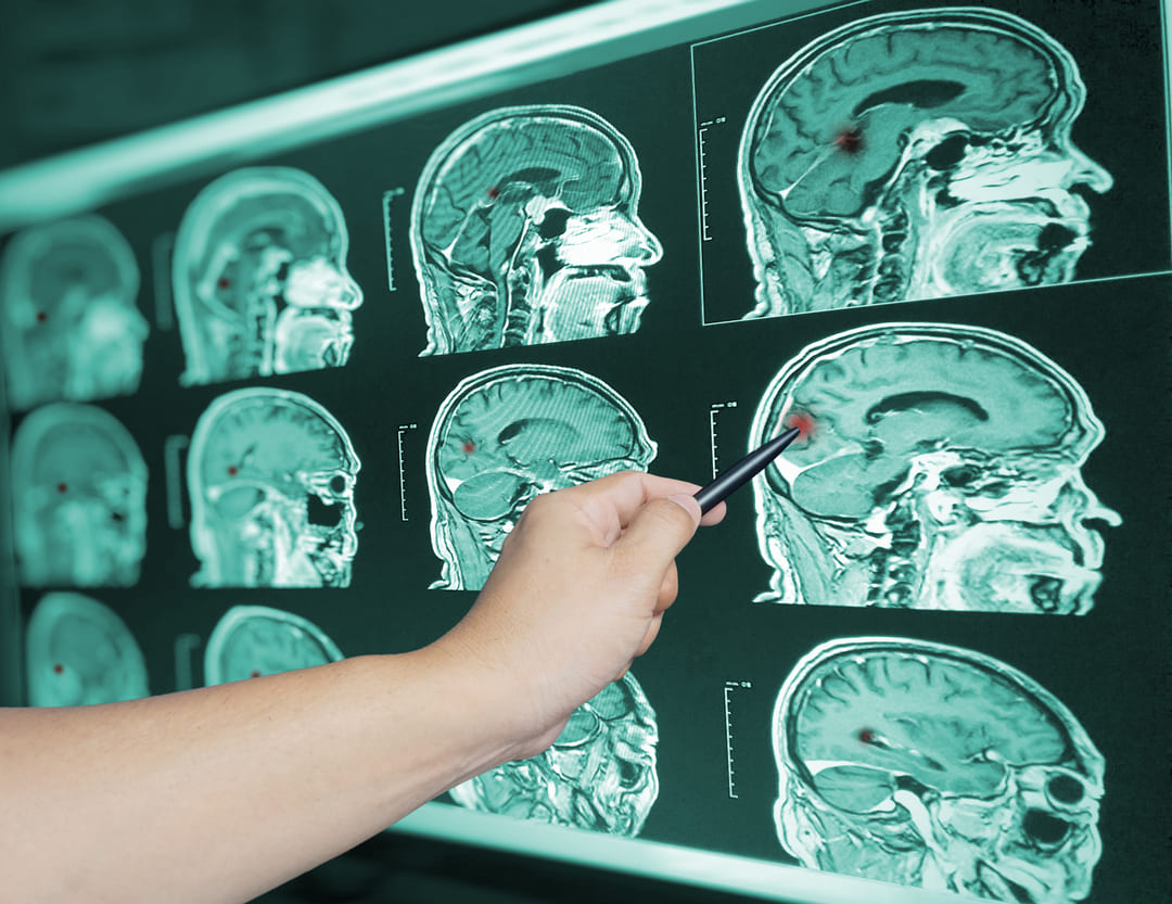 TBI and PTSD (Unlocking Your VA Benefits)