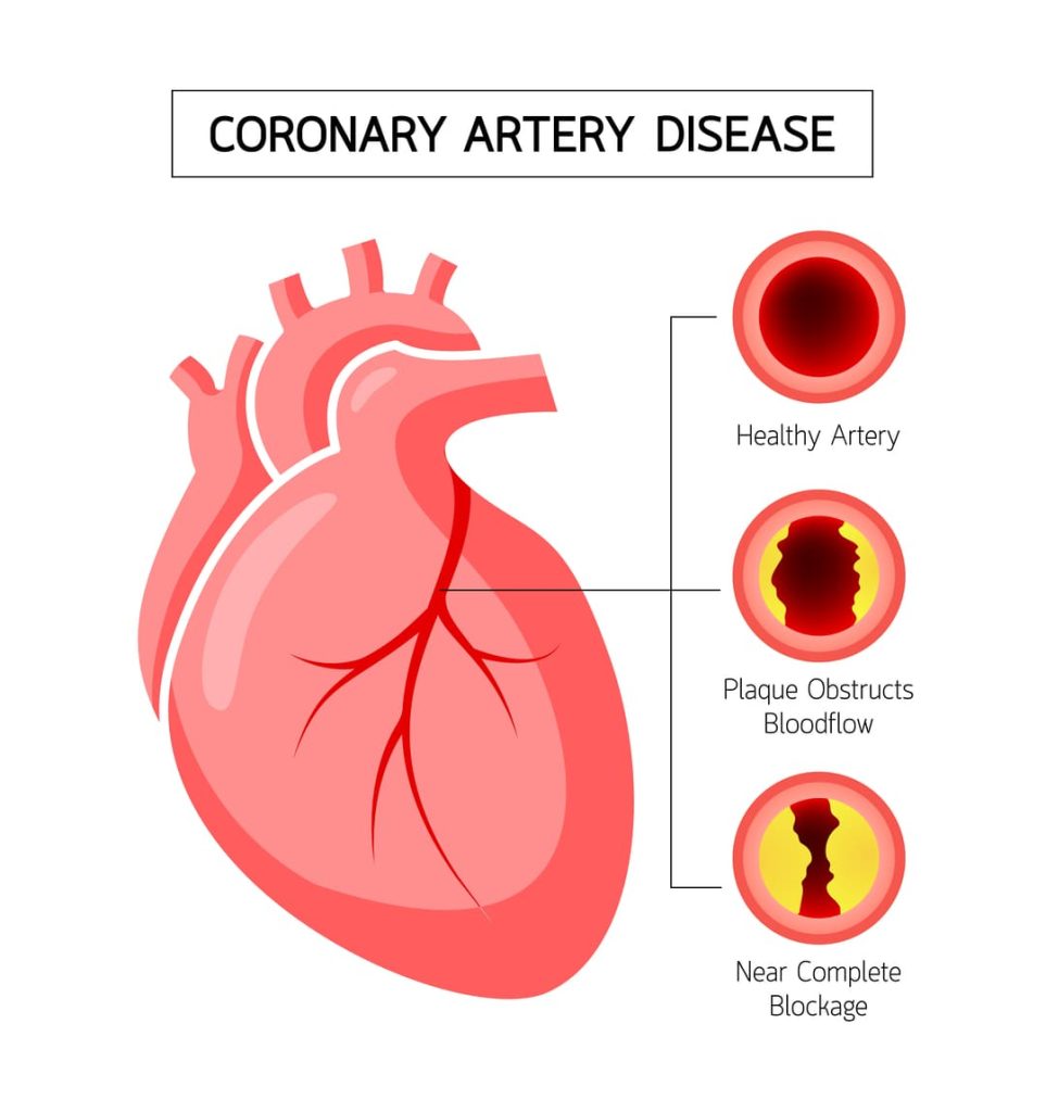 ISCHEMIC HEART DISEASE AKA CORONARY ARTERY DISEASE CAD