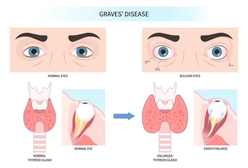 GRAVES DISEASE SYMPTOMS