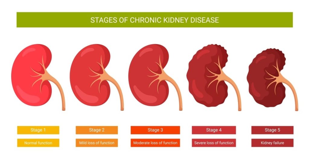 STAGES OF CHRONIC KIDNEY DISEASE