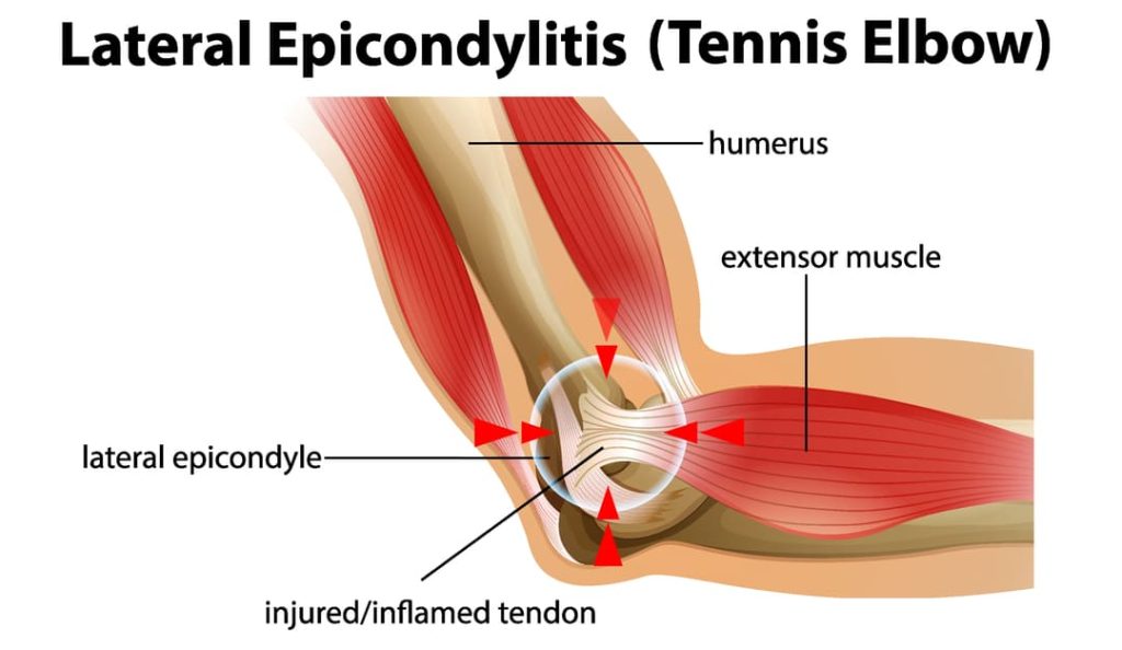 VA DISABILITY TENNIS ELBOW DIAGRAM