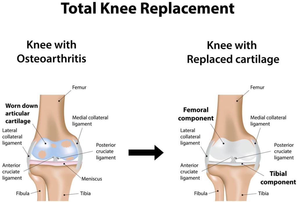 Knee Replacement VA Disability: 5 Key Facts