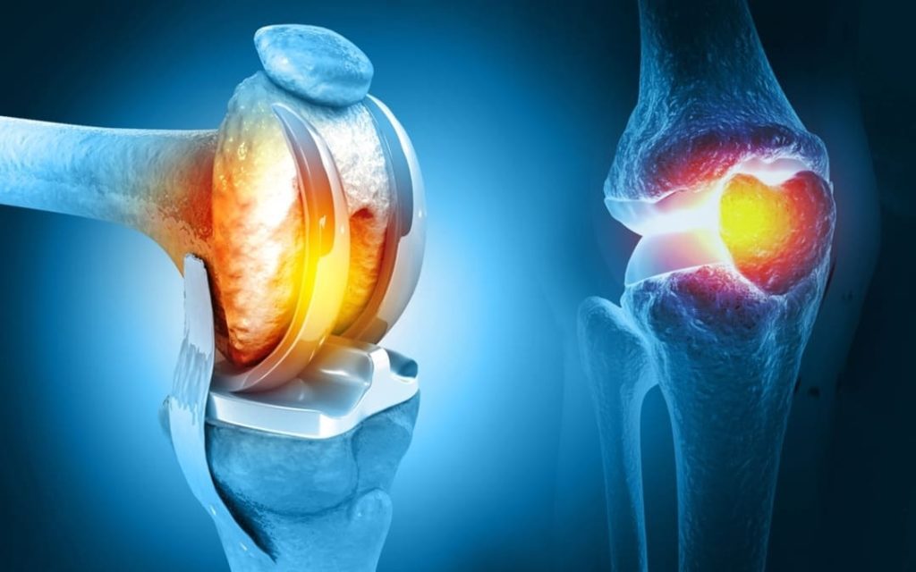 VA RATING FOR KNEE REPLACEMENT SCAR