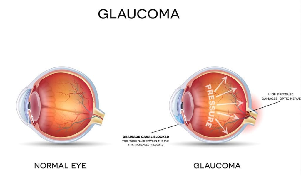 GLAUCOMA VA DISABILITY