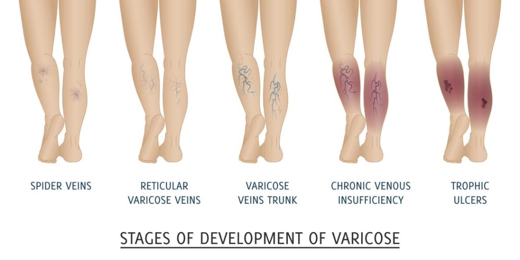 STAGES OF VARICOSE VEINS INFOGRAPHIC