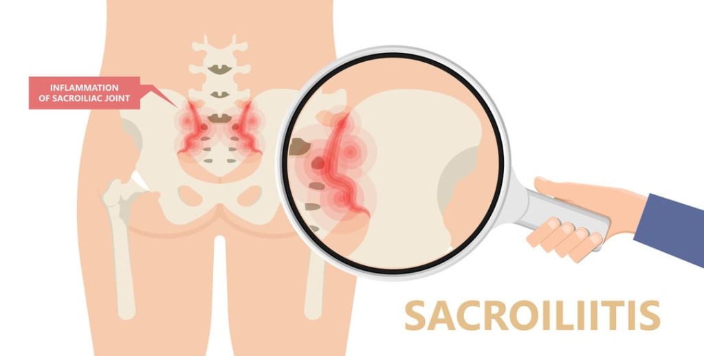 SACROILIITIS INFOGRAPHIC