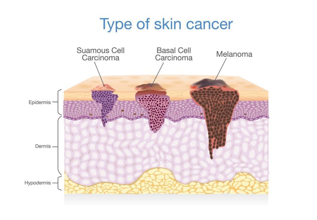 VA COMPENSATION FOR SQUAMOUS CELL CARCINOMA