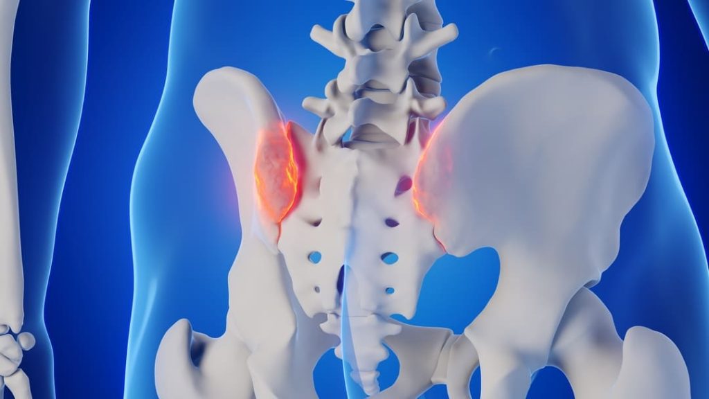 VA DISABILITY RATING FOR SACROILIITIS