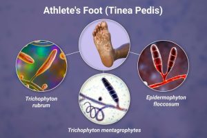 How to Get a Tinea Pedis VA Rating