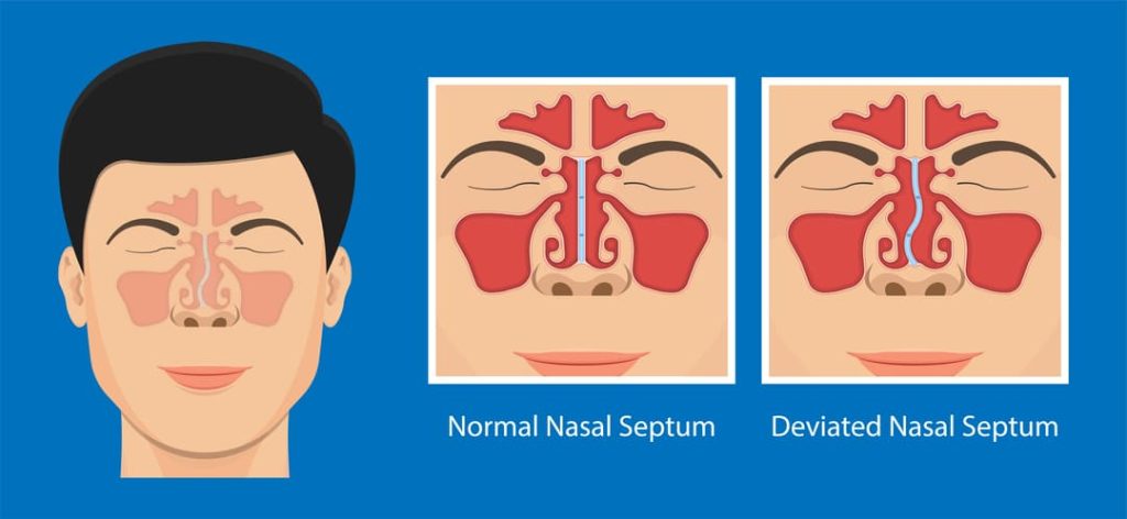 infographic comparing a normal nasal septum with a deviated nasal septum.