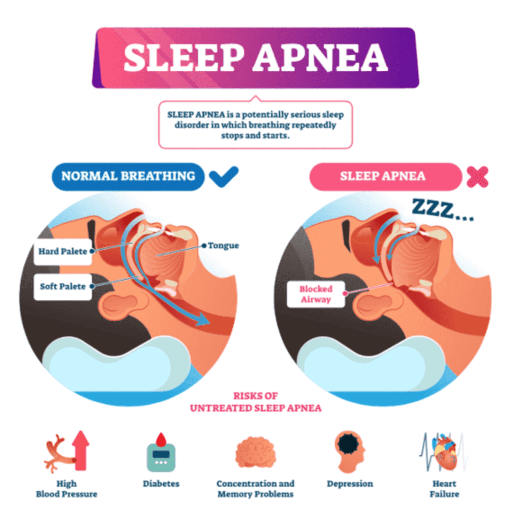 Sleep Apnea Infographic.