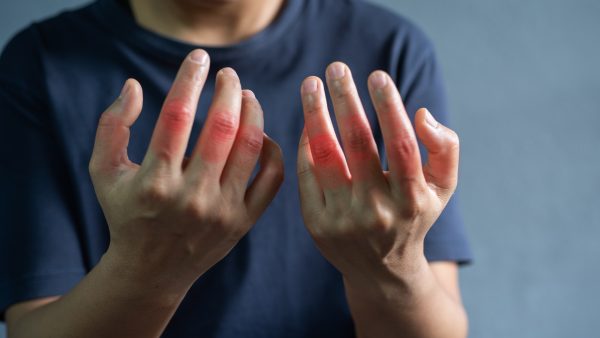 VA Rating for Rheumatoid Arthritis