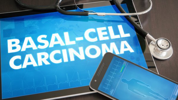 What is the Basal Cell Carcinoma VA Rating