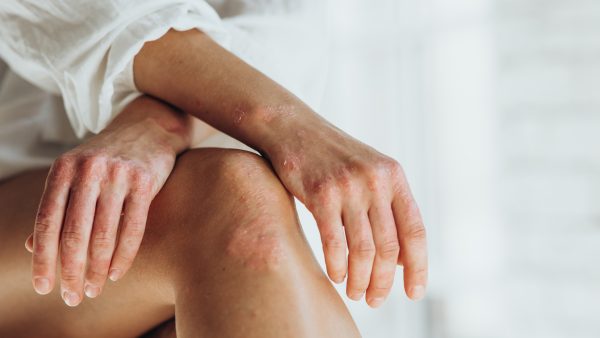 What is the VA Rating for Psoriasis