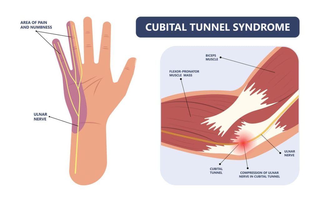 va rating for cubital tunnel syndrome