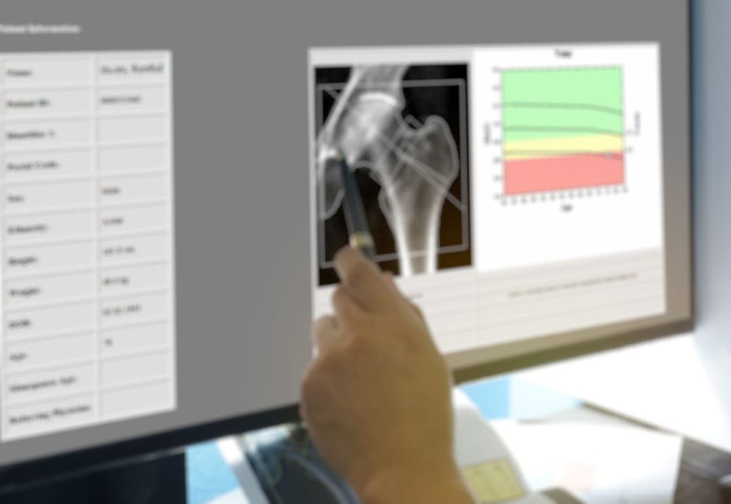 OSTEOPOROSIS VA RATINGS FAQS