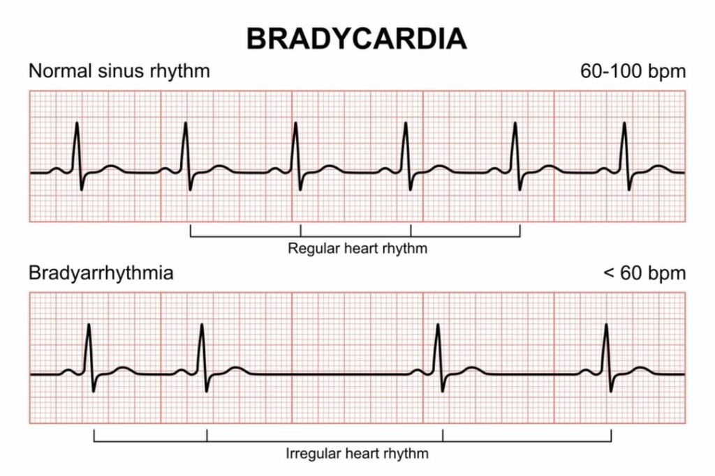 BRADYCARDIA VS NORMAL SINUS RHYTHM EKG