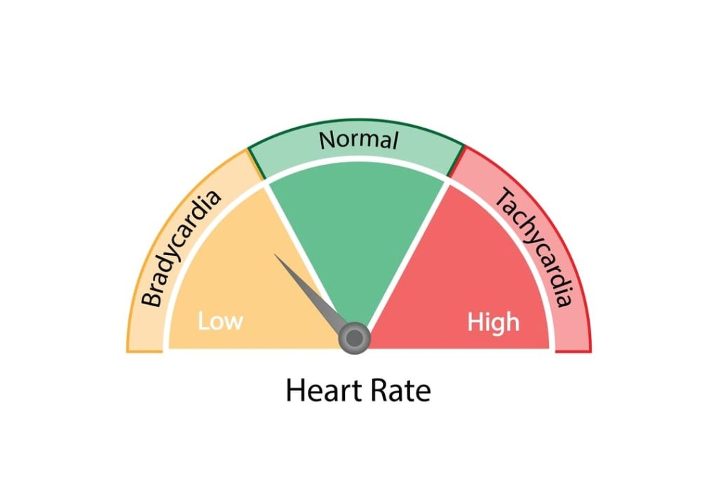 SINUS BRADYCARDIA VA RATING