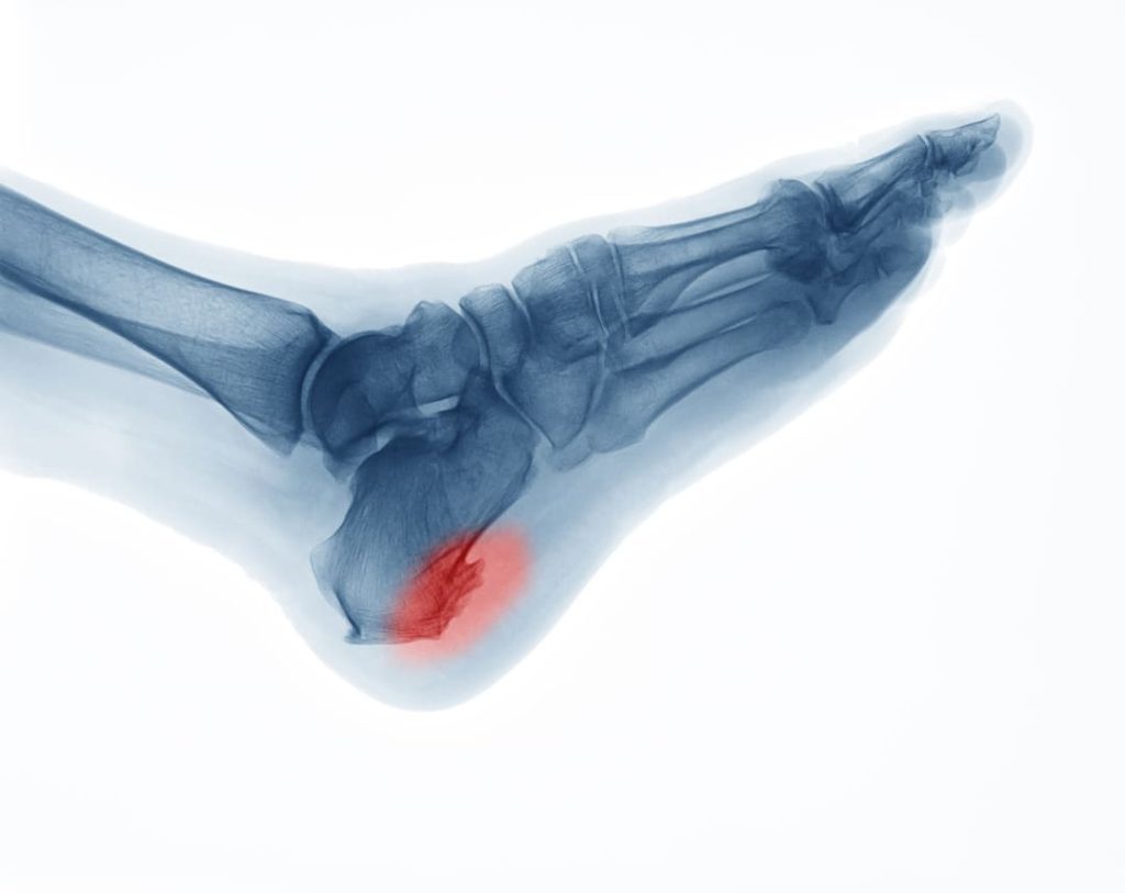 VA RATING FOR BILATERAL HEEL SPURS