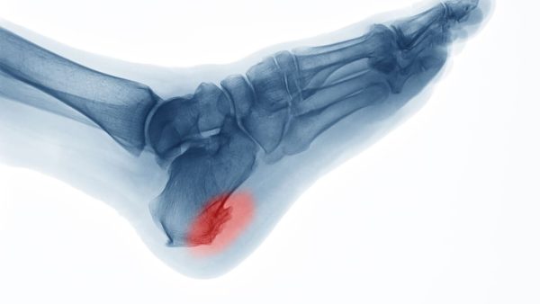 VA RATING FOR BILATERAL HEEL SPURS.