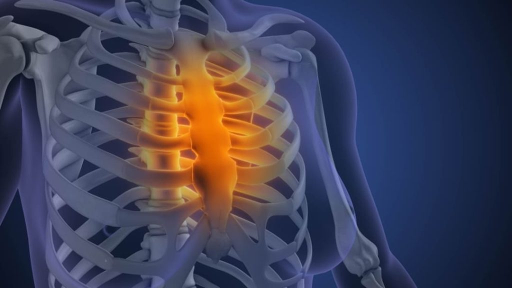 COSTOCHONDRITIS VA RATING