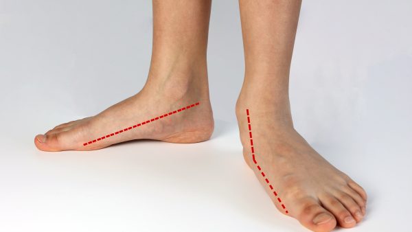 VA Disability for Flat Feet