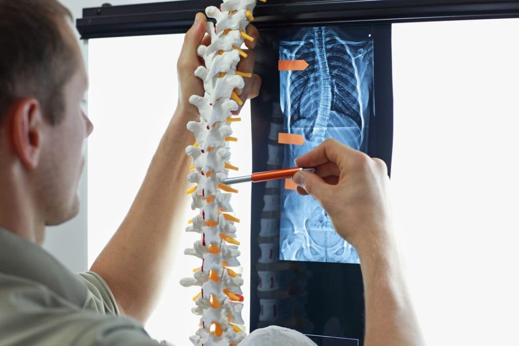 SCOLIOSIS VA RATING