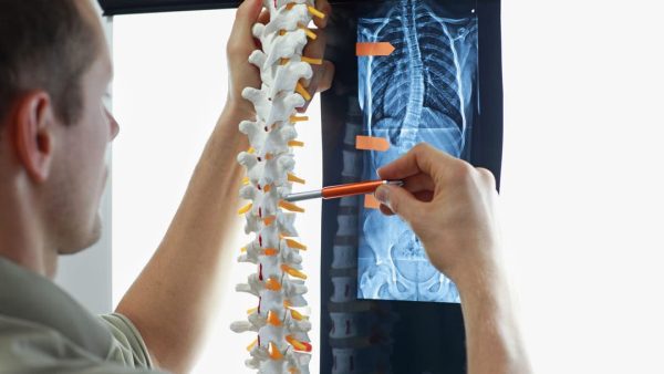 SCOLIOSIS VA RATING.