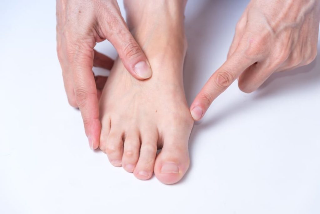HALLUX VALGUS VA RATING.