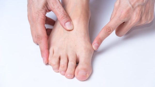 HALLUX VALGUS VA RATING.