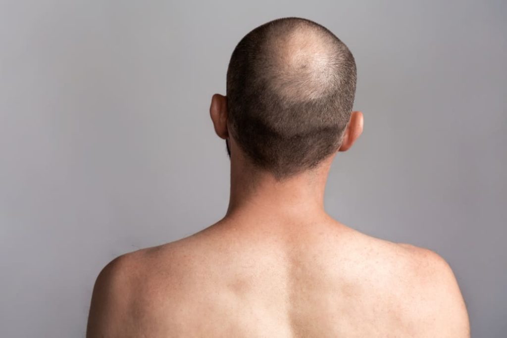 HAIR LOSS VA DISABILITY