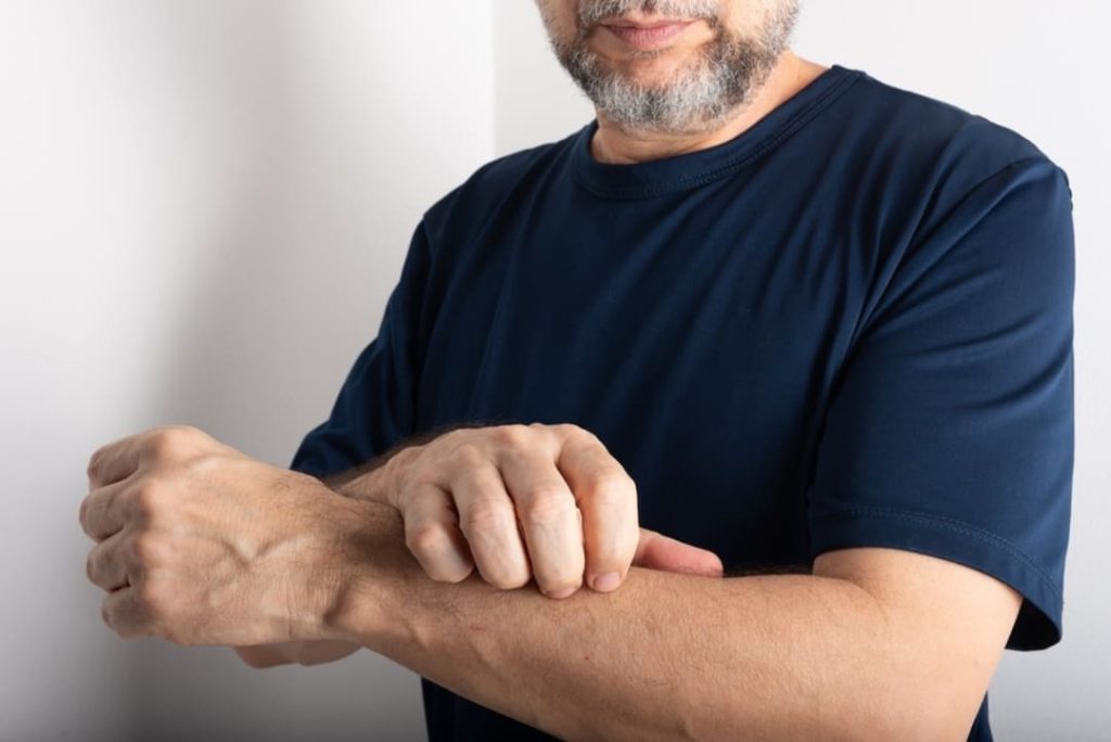 CHRONIC URTICARIA VA RATING